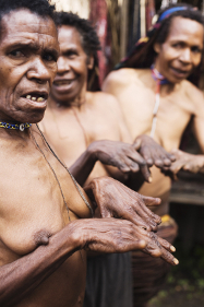 Dani-Stammesmitglieder mit abgetrennten Fingern © Dian Karlina